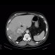 Splenic hemangioma, liver metastases, colon carcinoma: CT - Computed tomography